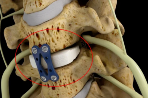 Anterior Cervical Spine Surgery